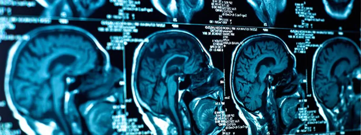 Brain Injuries